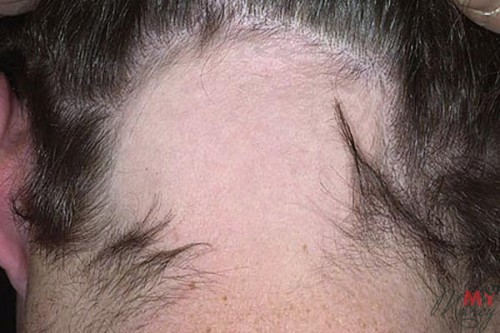 Субтотальная очаговая алопеция охватывает значительные участки кожи головы