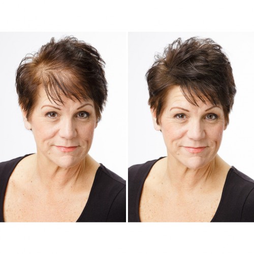 Мезотерапия для волос – до и после (фото: rabotanamore.ru)