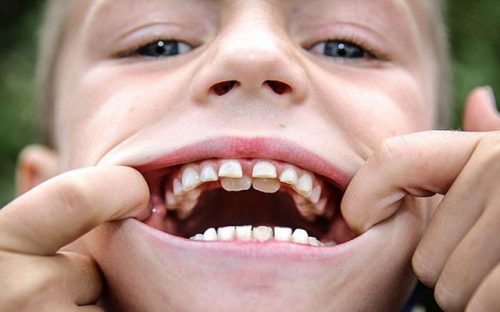 Если молочный зуб не выпал, а коренные растут, лучше обратиться к стоматологу (фото: www.jancel.ru)