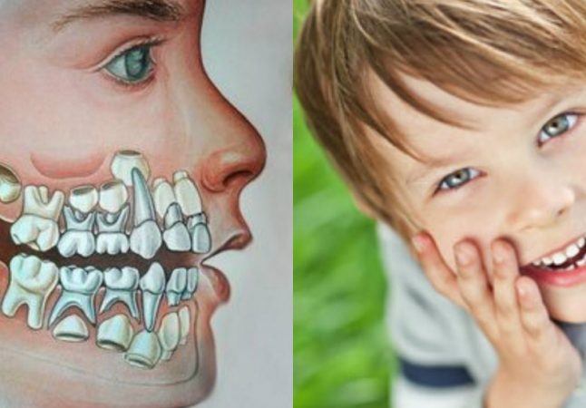 Череп ребенка до выпадения молочных зубов состоит из двойного зубного ряда