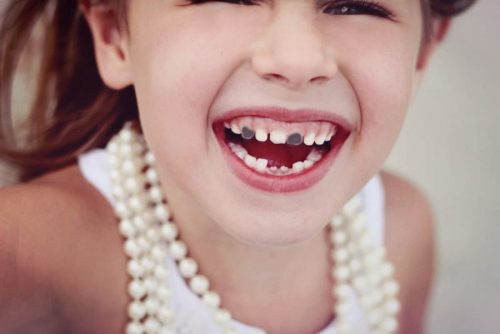 Если у ребенка чернеют молочные зубы — это может быть тревожным сигналом (фото: livestrong.com)