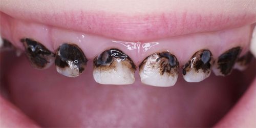 Посеребрение придает неэстетичный вид зубам (фото: tvoi-detki.ru)
