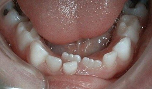 У ребенка 5 лет портятся молочные зубы что делать thumbnail