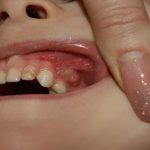 Свищ на десне молочного зуба: симптомы, виды лечения и возможные осложнения